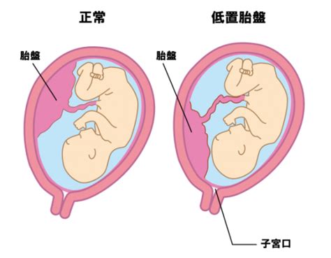 低位胎盤|低置胎盤 